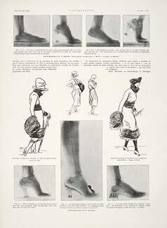 Le Talon Haut et la Santé Féminine, 1918 - High heels and health, SEM, Radiographies, Text by Dr Francis Heckel, 2 pages